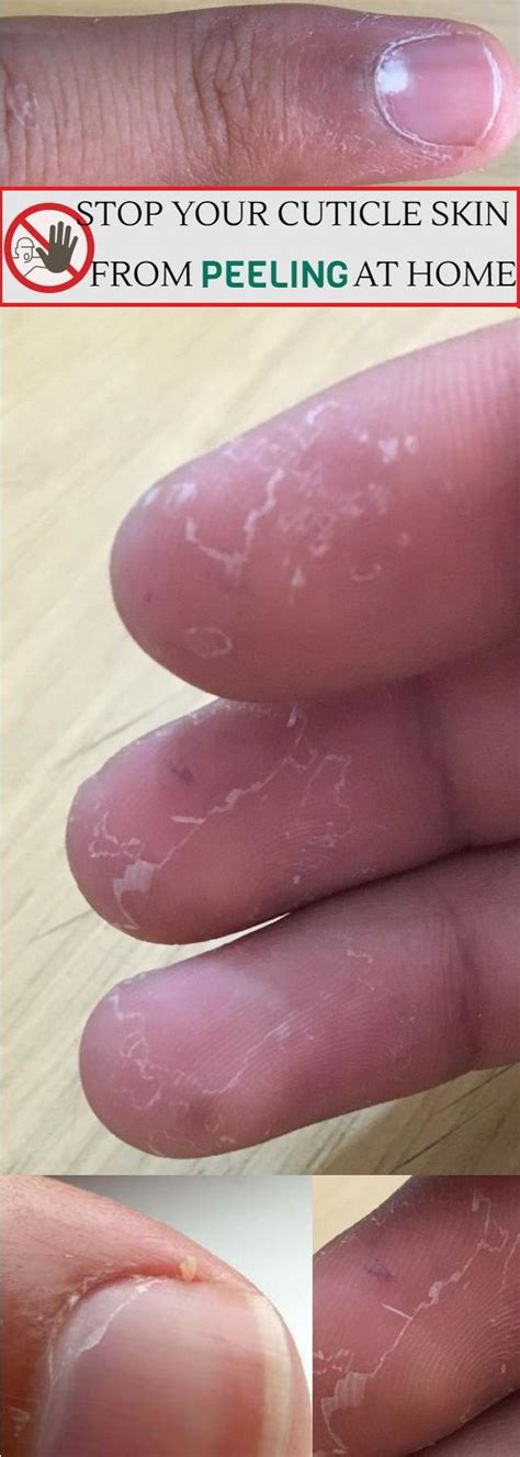 How can i stop my cuticles from peeling? Dry, peeling cuticles can be quite painful and look ...