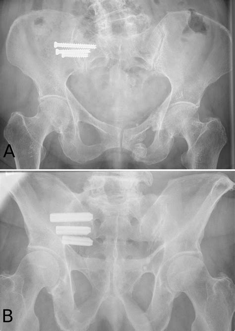 Surgical Revision After Sacroiliac Joint Fixation Or Fusion