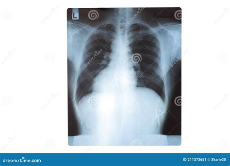 病人胸部x光片 医学教育 肺感染异常x线 柯维德19肺炎 库存图片 图片 包括有 辐射 转移 211373651