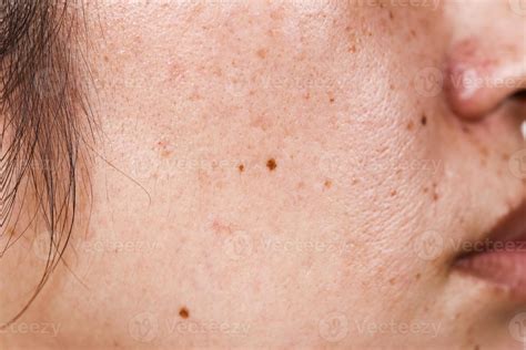 Womans Face With Large Pores Black Dots And Freckles On The Surface Of