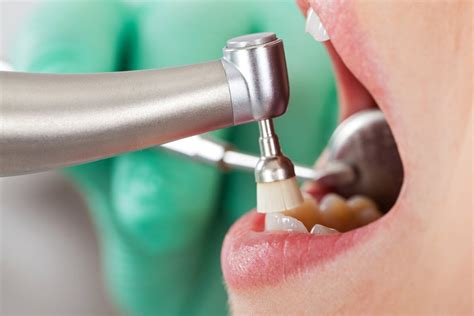 Limpieza Dental ¿cada Cuánto Se Debe Realizar Mejor Con Salud