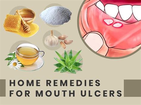 10 Home Remedies That May Help Heal Mouth Ulcers In 2020 Treating