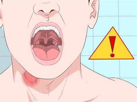 How To Get Rid Of A Sore Throat Quickly With Pictures WikiHow