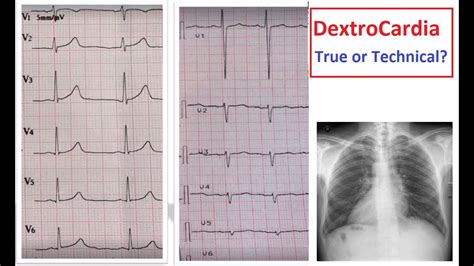 Dextrocardiatechnical Dextrocardia Ecg Features Youtube