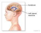 Brain tumours in children often lack specific neurological signs in their clinical presentation. Brain tumor - children. Causes, symptoms, treatment Brain ...