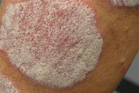 Review Of Conventional Systemic Therapies For Severe Psoriasis