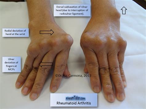 Rheumatoid Arthritis · Rheumtutor