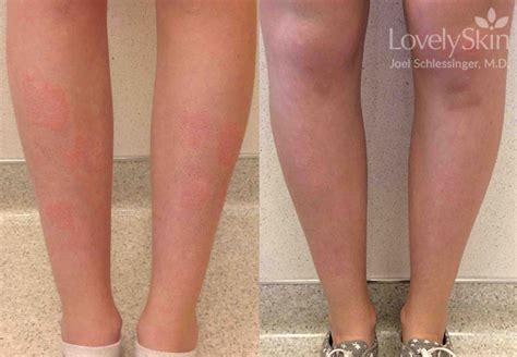 Psoriasis Before And After Photos Skin Specialists Pc