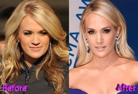 Carrie Underwood Before And After Cosmetic Surgery Laser Hair Laser
