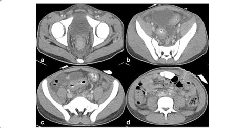 Contrast Enhanced Computed Tomography Of The Abdomen And Pelvis A C