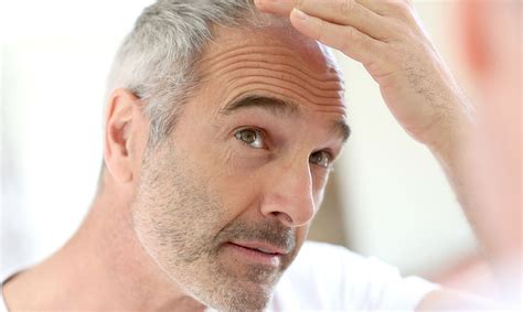 If you have excessive hair loss, you will need medical intervention. Dandruff, Hair Loss is No Longer a Problem