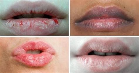 Kulit bibir mungkin saja tampak lebih gelap. Ini 7 Punca Kenapa Bibir Kita Merekah Dan Kering | GEGAR