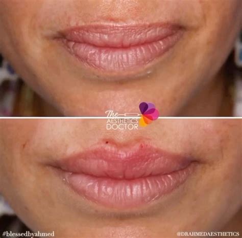Lip Filler And Lip Augmentation Lip Enhancement The Aesthetics Doctor