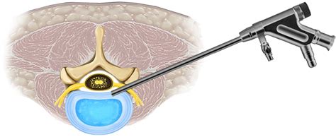 Transforaminal Endoscopic Lumbar Discectomy Basic Concepts And