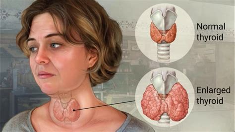 9 Easy And Effective Habits That Can Help Fight Goiter Must Read