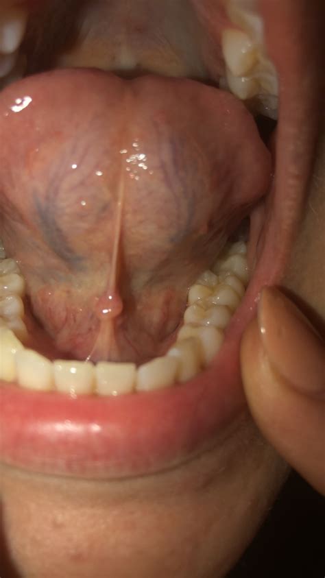 Bumps Under Tongue Help Salivary Gland Disorders Forums Patient