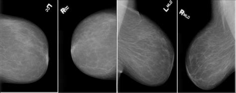 Cc And Mlo Views Of A Patient From Ddsm Dataset From Left To Right