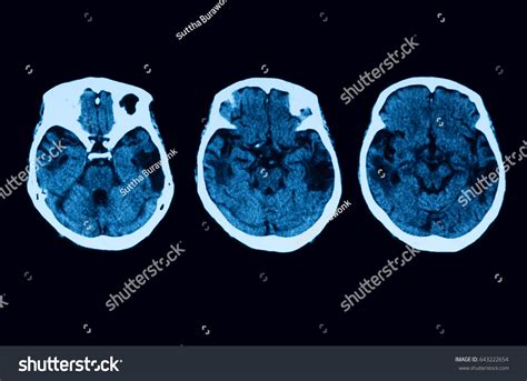 Computed Tomography Ct Scan Brain Old Stock Photo 643222654 Shutterstock
