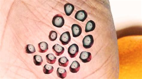 Trypophobia Is It Real And What Are The Triggers