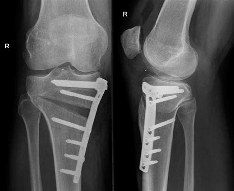 Two Year Results Of Open Wedge High Tibial Osteotomy With Fixation By