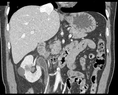 Transitional Cell Carcinoma Of The Right Renal Pelvis Ureter And