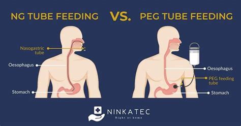 Gastric Feeding Tube