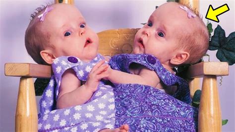 These Twins Were Born Conjoined And Later Separated You Won T Believe How They Look Now Youtube