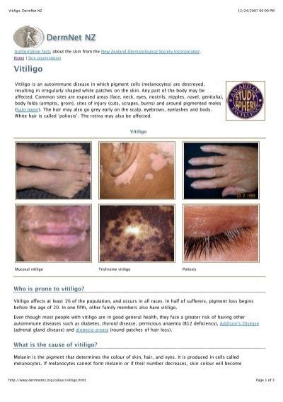 Vitiligo Dermnet Nz Susmunity Dermatology Service