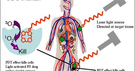 Terapia Fotodinámica Cancer Alternativas Oncológicas