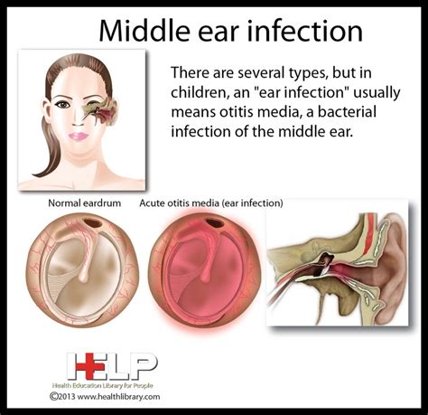Middle Ear Infection Medical Knowledge Nursing Care Plan Middle Ear