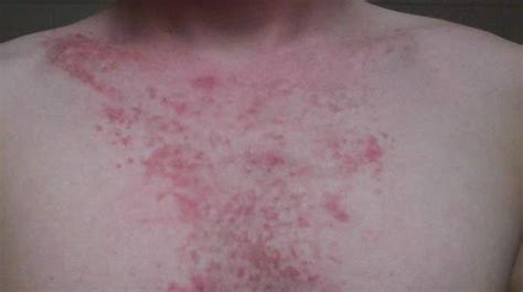 Causes Of Red Rash On Chest