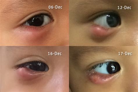 Kelopak mata kendur biasanya merupakan salah satu tanda penuaan pertama, tetapi terkadang ini terjadi karena kerusakan saraf, cedera di sekitar mata, atau. Saat Akas Bintitan Hingga Harus Diinsisi
