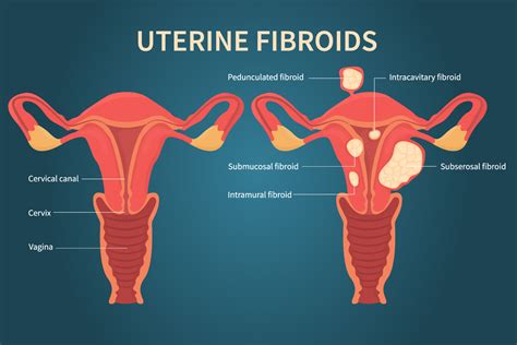 Uterine Fibroid Embolization Ufe Mark Fibroid Care