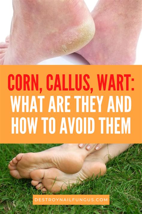 Corn Versus Callus Versus Wart How Can You Tell Which One