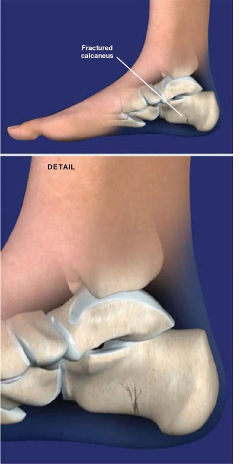 Fracture Of The Heel Bone Calcaneus