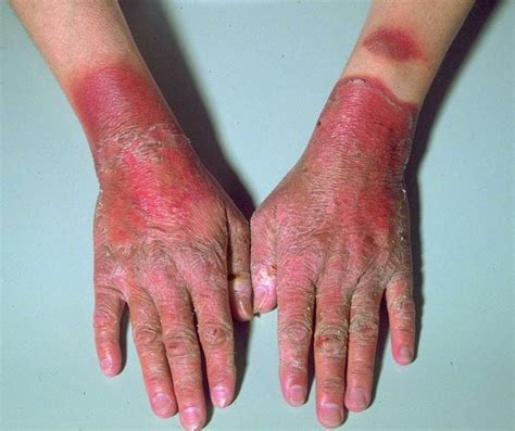 Image Rash On The Hands Due To Pellagra Msd Manual Consumer Version