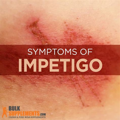 Impetigo Symptoms Causes And Treatment