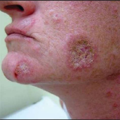 Pdf Cutaneous Lupus Erythematosus Issues In Diagnosis And Treatment
