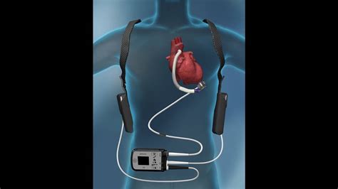 What Are The Benefits Risks Of Heart Pump Implants Miami Herald