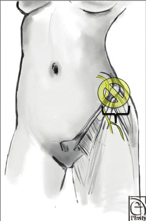 Split flexibility was assessed by measuring the height of the anterior superior iliac spine of the rear leg from the floor. Diagram of the unsafe zone of dissection around the ...