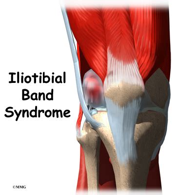 Iliotibial Band Syndrome Orthogate