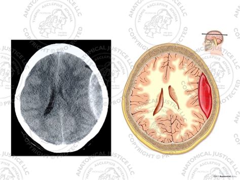Ct Of The Brain With Left Epidural Hematoma No Text