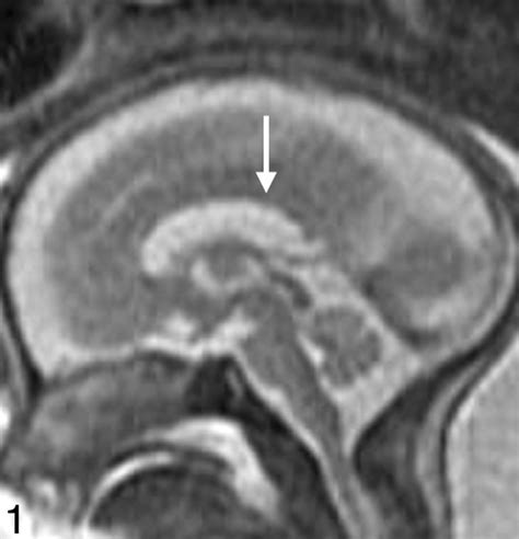 Magnetic Resonance Imaging Of The Fetal Brain And Spine An