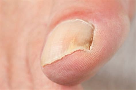 How To Treat Common Nail Problems Step To Health