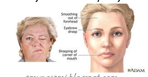 Bell's palsy adalah kondisi dimana salah satu sisi wajah mengalami kelumpuhan otot tetapi mudah disembuhkan atau sembuh dengan sendirinya. BELL'S PALSY : Penyakit Bell's Palsy Berpuluh Tahun Sembuh ...