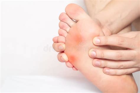 Red And Inflamed Skin On The Sole Of The Patient S Feet Pain From
