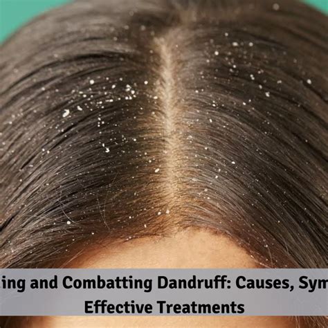 Understanding And Combatting Dandruff Causes Symptoms And Effective