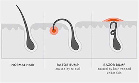 6 Home Remedies To Get Rid Of Razor Bumps Fast 2023