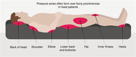 Pressure Injury 101 Stage 2 Pressure Ulcers