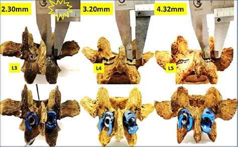 Scielo Brasil Cadaveric Study Of Anatomical Measurement Of Isthmus